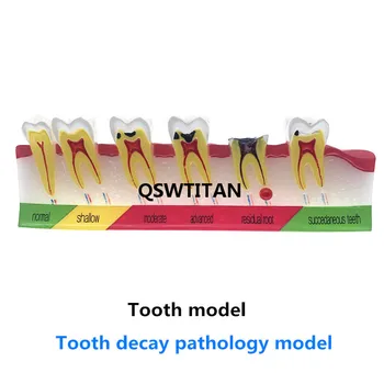 Poučevanje Študija Zobni zob zobni gnilobi, ki je Razvoj decayed zob Analiza Modela